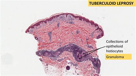 LEPROSY- Tuberculoid & Lepromatous | Pathology Made Simple