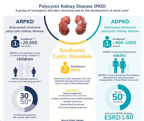 Polycystic Kidney Disease (PKD) - Infographic - NephU