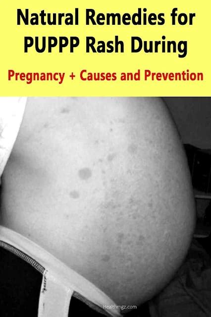 Natural Remedies for PUPPP Rash During Pregnancy: Causes and Prevention ...