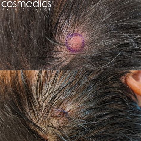 Cyst Removal London Surgical Treatment | Cosmedics Skin Clinics