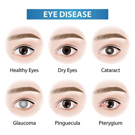 Beware of These Common Eye Diseases | Bangkok Hospital