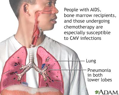 CMV pneumonia