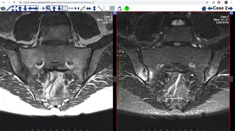 Sacroiliac Joint Erosion