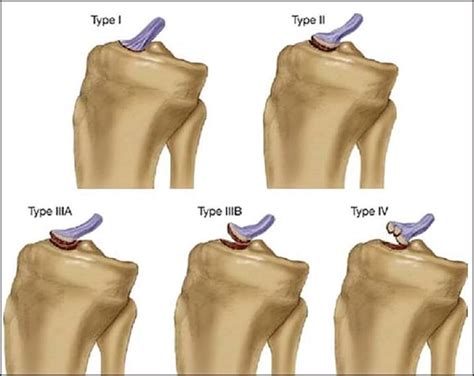 Intercondylar Eminence