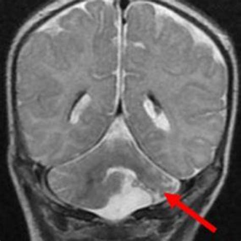 Unilateral cerebellar hypoplasia - A case report | Eurorad