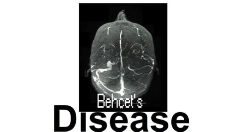 Behcet's Disease: 8+ Symptoms, Causes, Prevention, And Diagnosis » 2024