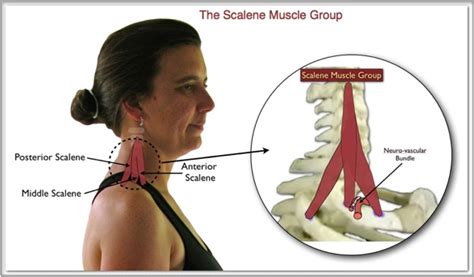 The Scalene Trigger Points: Upper Body Troublemakers ...