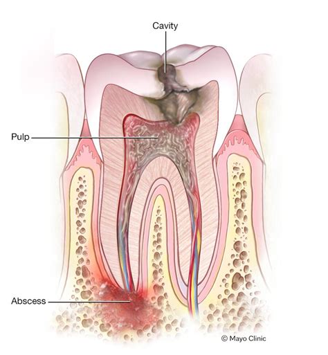 Absceso dental - Síntomas y causas - Mayo Clinic