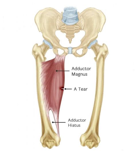 Adductor Injury - Running Tips for Chubby People | The Chubby Runner