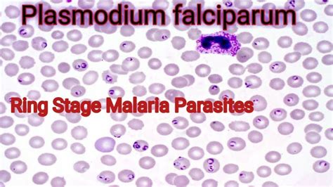 Plasmodium Falciparum Under Microscope