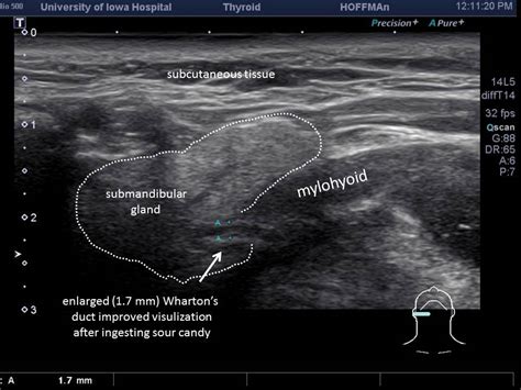 Salivary Gland Ultrasound Anatomy | Images and Photos finder