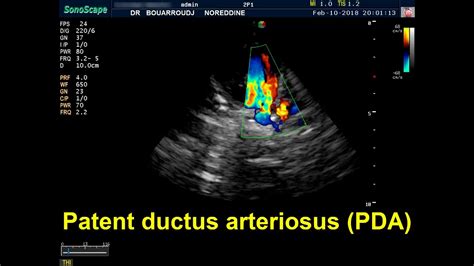 Conus Arteriosus