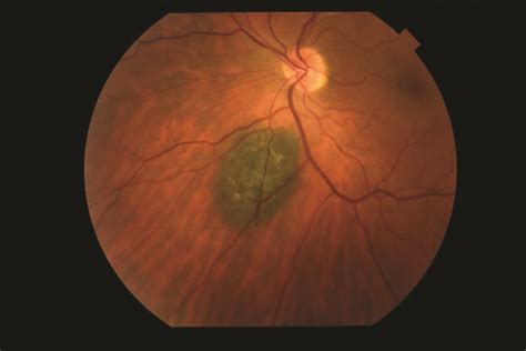 Choroidal Nevus With Lipofuscin