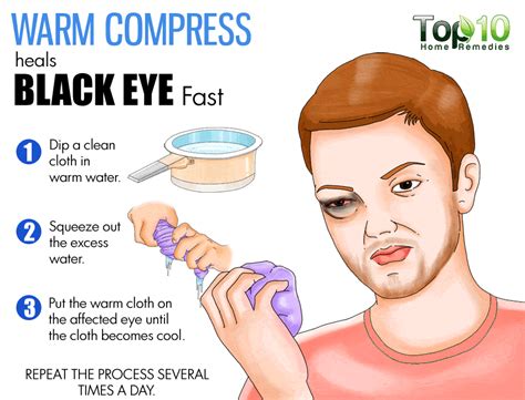 How to Get Rid of a Black Eye Fast | Top 10 Home Remedies