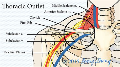 Thoracic Outlet Syndrome | Johns Hopkins Medicine