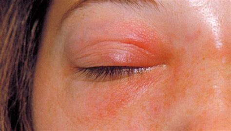 Orbital cellulitis: Symptoms, causes, and treatment