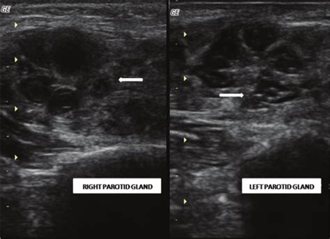 Ultrasonogram of the right and left parotid gland of a patient with ...