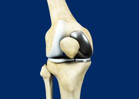 Unicondylar Knee Replacement New York City | Knee Implant Nassau County