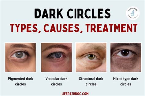 Dark Circles Under the Eyes: Causes, Types & Treatments