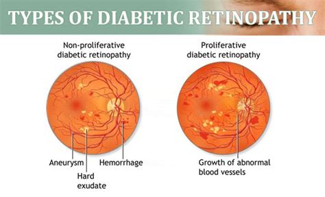 Diabetic Retinopathy - Women Fitness