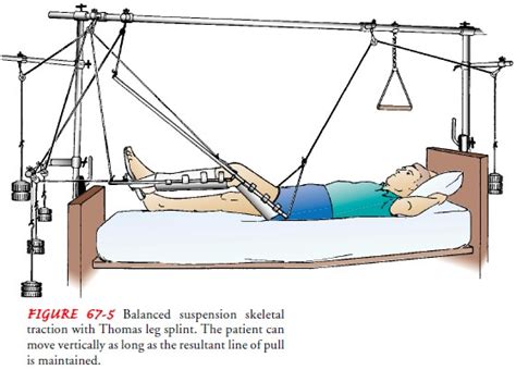 Steinmann Pin Traction