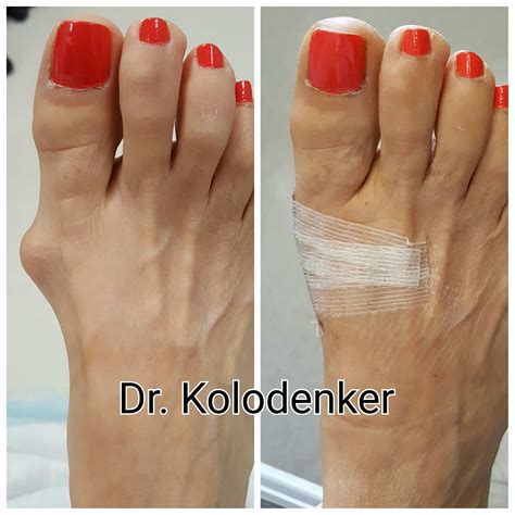 Minimally Invasive Bunion Surgery in Orange County