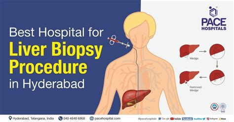 Liver Biopsy Procedure in Hyderabad – Types, Indications and Cost