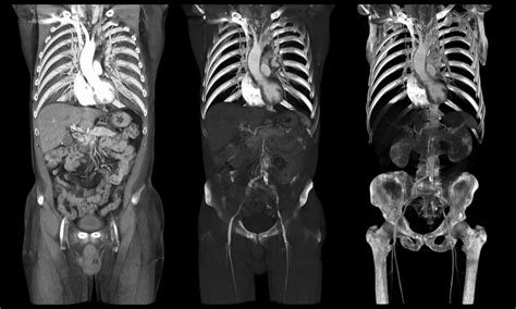 What Does A Ct Scan Do To Your Body