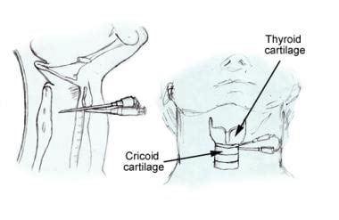 Emergency Airway Management Part 4: Cricothyroidotomy, 41% OFF