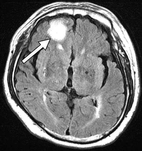 Traumatic Brain Injury Mri