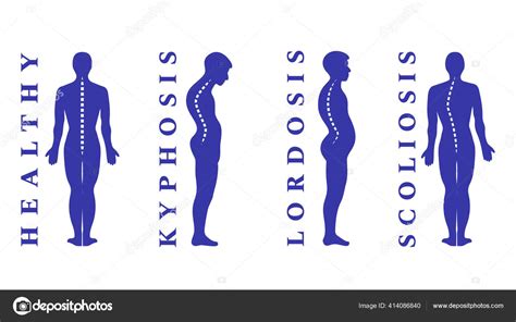 Diseases Spine Scoliosis Lordosis Kyphosis Body Posture Defects Back ...