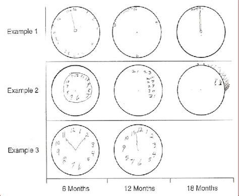 Three examples of clock drawings showing deterioration in dementia [11 ...