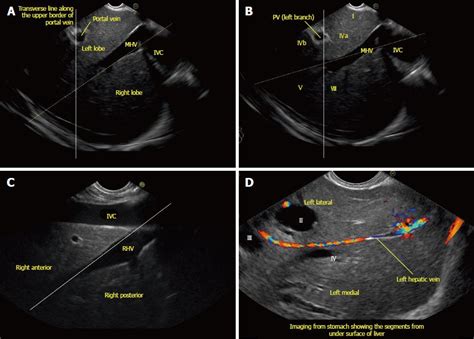 Liver Segment 7 Ultrasound