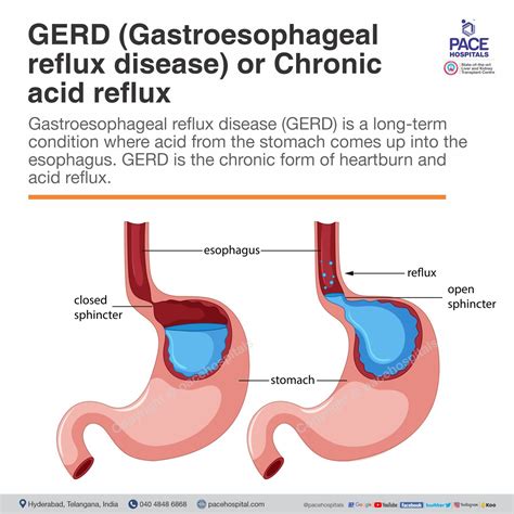 GERD or Chronic Acid Reflux - Symptoms, Causes and Treatment