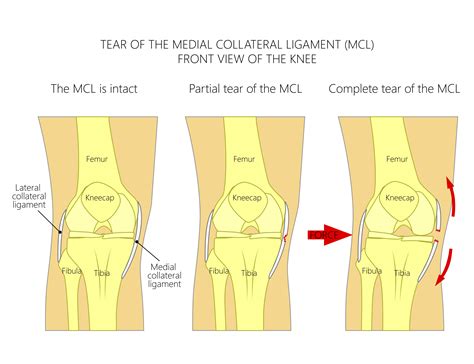 Acl and mcl surgery