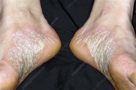 Acute psoriasis on the feet - Stock Image - C004/2473 - Science Photo ...