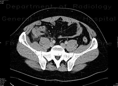 Radiology case: Inflammation of the cecum