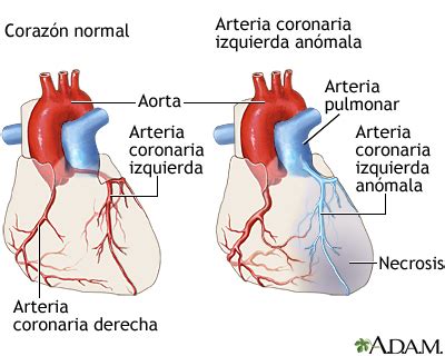 Arteria coronaria izquierda anómala: MedlinePlus enciclopedia médica ...