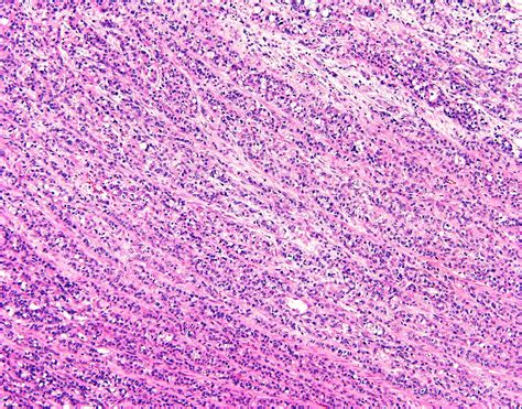 Pathology Outlines - Goblet cell adenocarcinoma