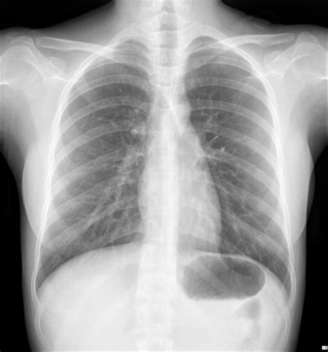 Chest X-Ray Interpretation in patients with fever, cough, colds ...