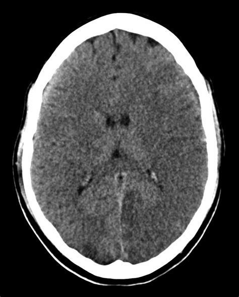 Acute infarct – CT - Radiology at St. Vincent's University Hospital