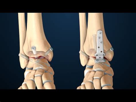 Triple arthrodesis surgery of right ankle (pt1) | Doovi