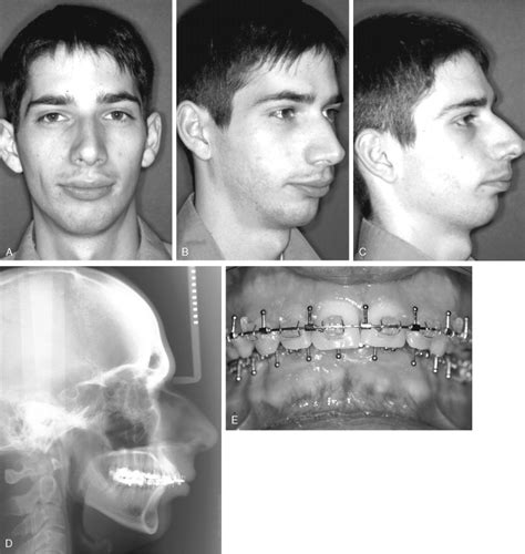 SAGITTAL SPLIT OSTEOTOMY | Pocket Dentistry