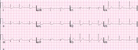 Dr. Smith's ECG Blog: Inferior and Posterior STEMI. What else?