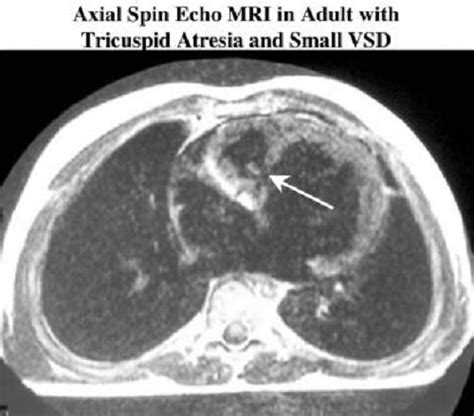 The Common Symptoms, Diagnosis, And Treatments For Tricuspid Atresia ...