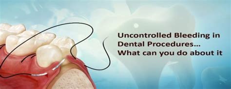 Uncontrolled Bleeding in Dental Procedures: Use of Sutures - ICPA ...