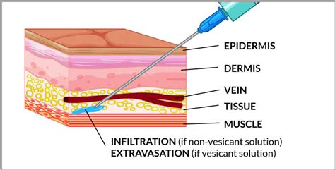 Infiltration and Extravasation: Complications of Peripherally Inserted ...