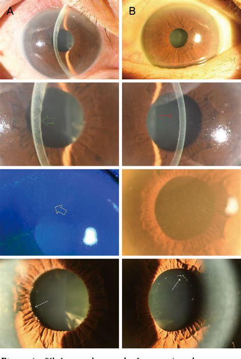 Figure 1 from A Case with Corneal Decompensation in Pseudoexfoliation ...