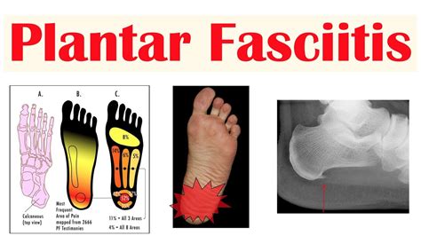 Plantar Fasciitis (Heel Pain) | Causes, Signs & Symptoms, Diagnosis ...