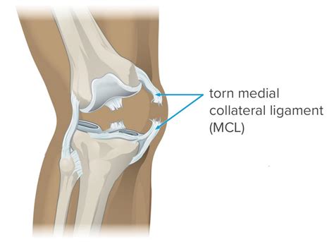 Desgarro del MCL: síntomas, diagnóstico y tratamiento - Salud - Tudo